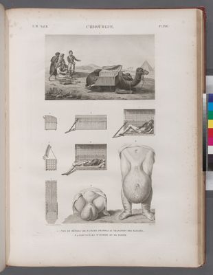Chirurgie. 1-7. Vue et détails de paniers propres au transport des blessés; 8.9. Sarcocéles d'homme et de femme.